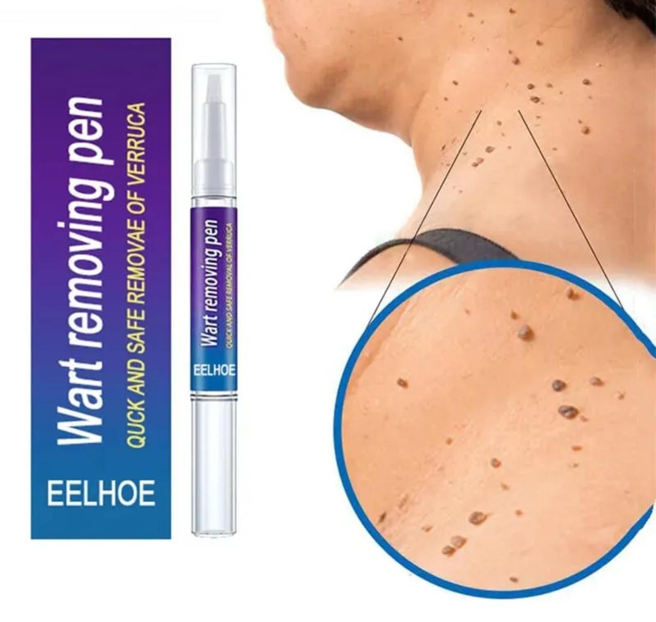 Wart Removal Pen, Removing Against Moles Pimple Patch Remove Black Dot