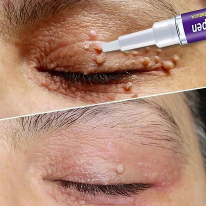 Wart Removal Pen, Removing Against Moles Pimple Patch Remove Black Dot