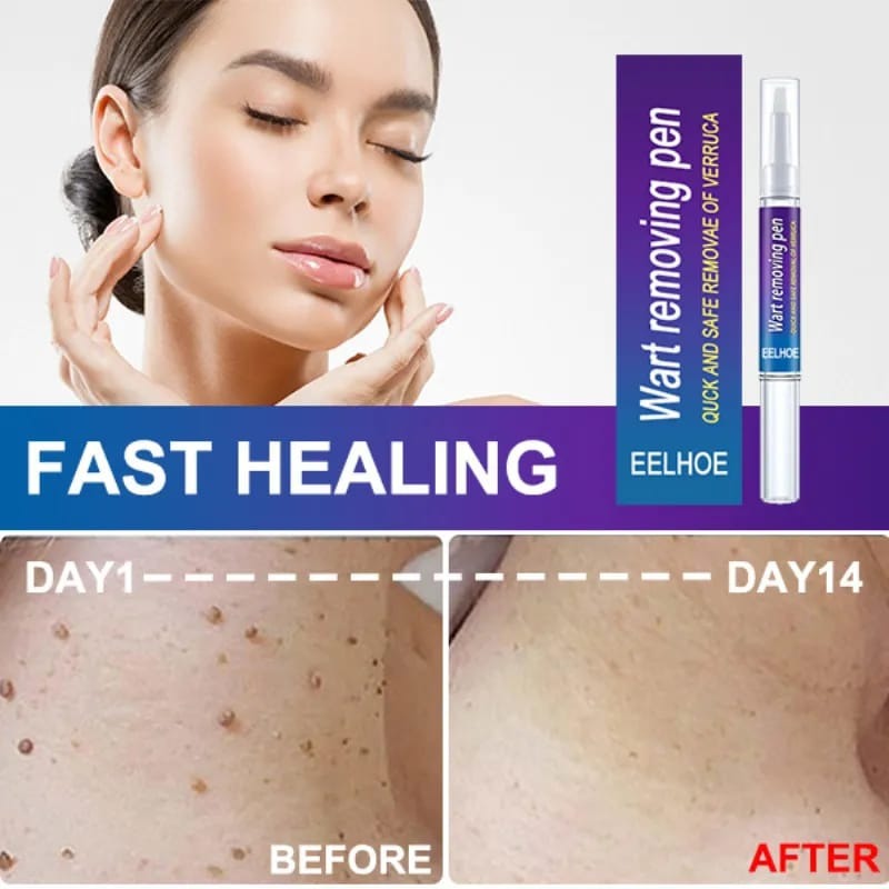 Wart Removal Pen, Removing Against Moles Pimple Patch Remove Black Dot